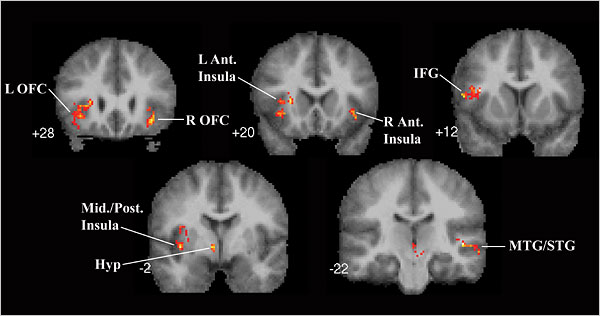 Images from an experiment to locate the neural regions of the brain involved in listening to music. Daniel Levitin and another scientist scanned the brains of 13 people as they listened to scrambled and unscrambled versions of a tune.